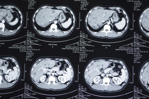 CT显示，林文的肝脏内多发低密度结节影